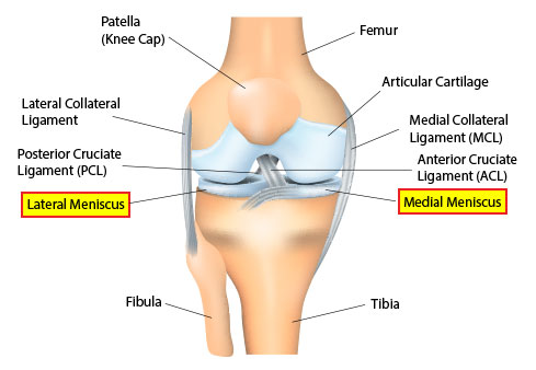 medial meniscus tear