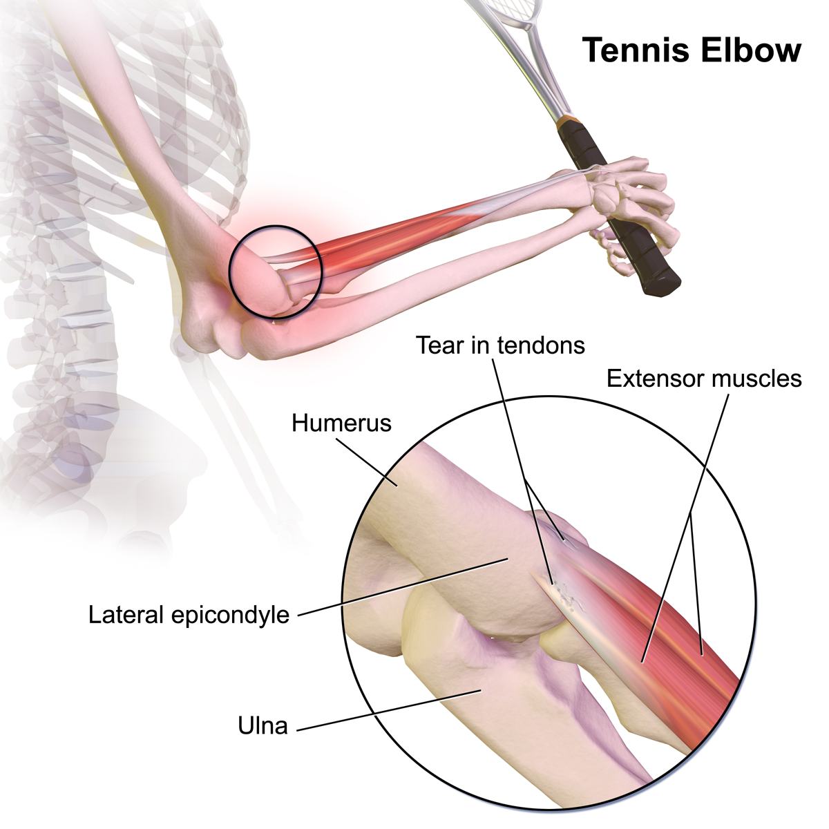 elbow tendon injury symptoms