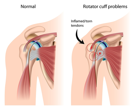 rotator cuff surgery recovery time