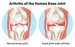 Knee arthritis