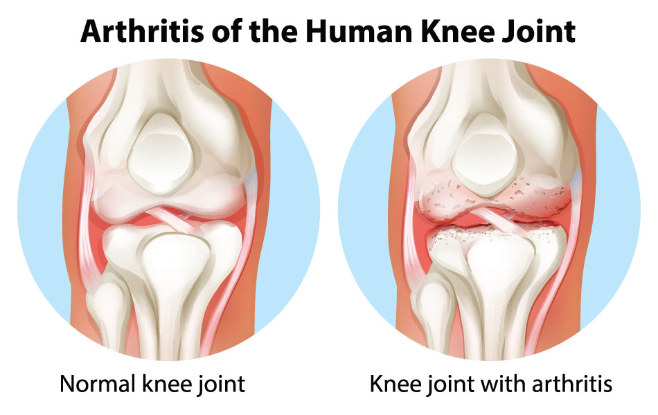 Knee Arthritis - Advanced Orthopedic & Sports Medicine Specialists