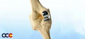 Unicompartmental Knee Replacement